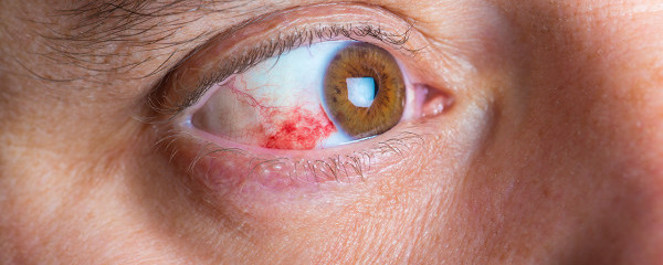 眼白有红血丝怎么回事导致眼白有红血丝的6种病因