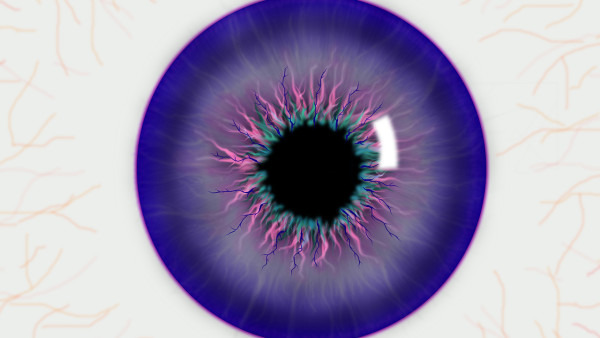 晶状体脱位所致青光眼是怎么回事 晶状体脱位所致青光眼的发病机制