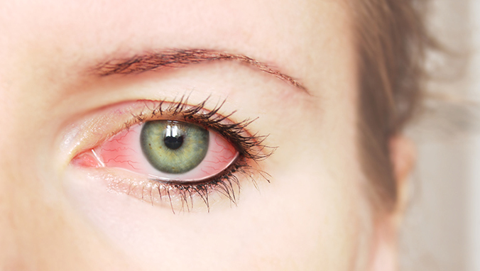 眼睛充血怎么快速消除 缓解眼睛充血的5个方法