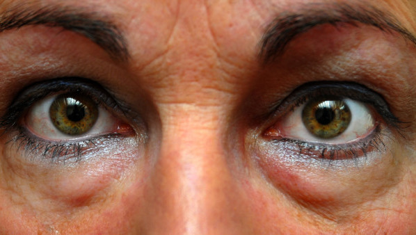 白眼球发黄有红血丝是什么原因 导致白眼球发黄的4种疾病