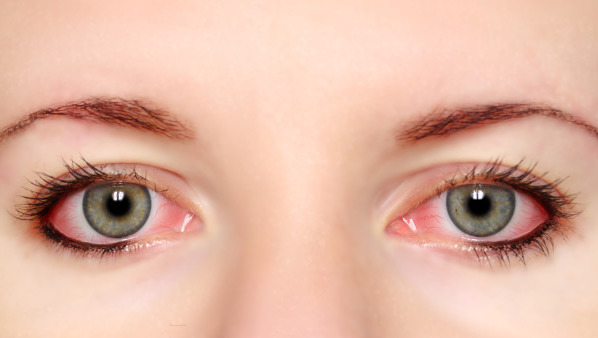 白眼球充血怎么办 白眼球充血的6个缓解方法