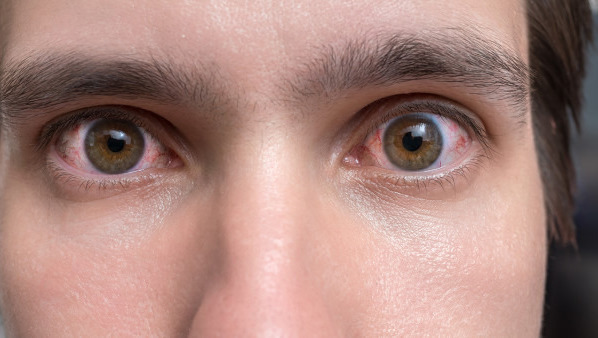 眼睛疼痒怎么回事 导致眼睛痒的7个病因