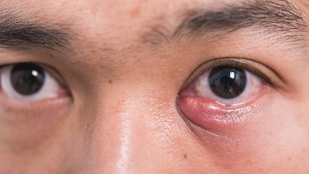 眼角疼红肿如何治疗 眼睛疼红肿的热敷疗法