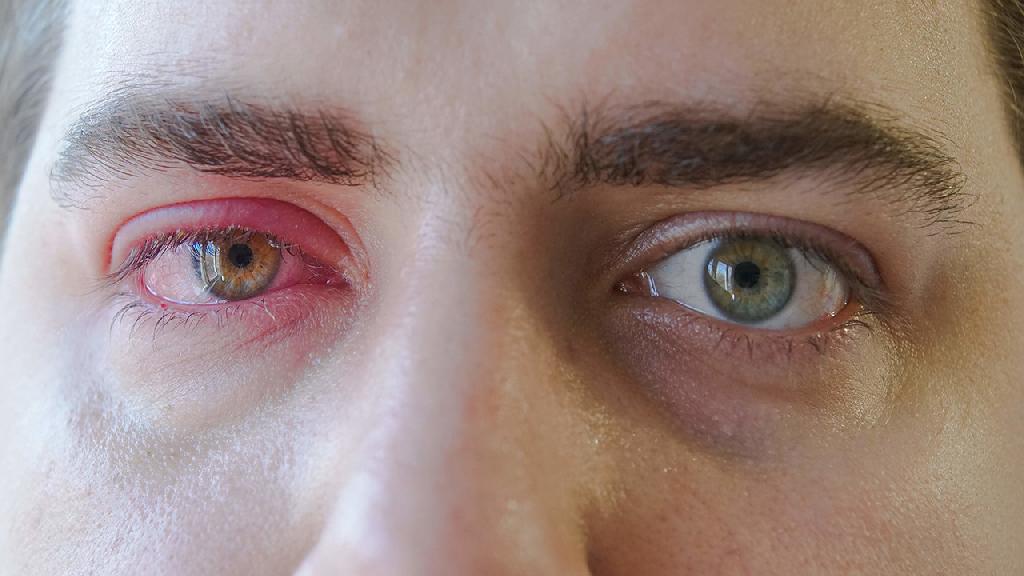 为什么眼睛会得角膜炎 眼睛得了角膜炎怎么办才好