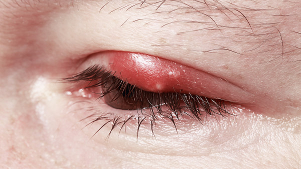 眼皮里长疙瘩怎么回事？平时用眼过度