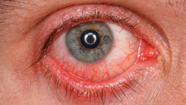 眼睛出血是怎么回事 眼睛出血是什么原因导致的
