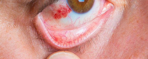 白眼球有红血块怎么办 白眼球有红血块如何进行治疗