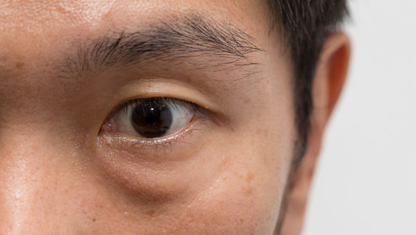 上眼皮浮肿是怎么回事 上眼皮浮肿的病因