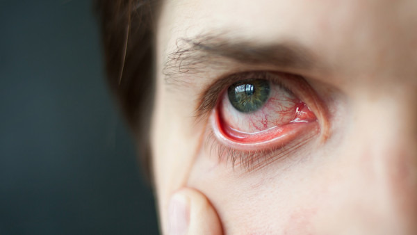 眼睛红血丝是什么原因造成的 眼睛红血丝怎么办才好