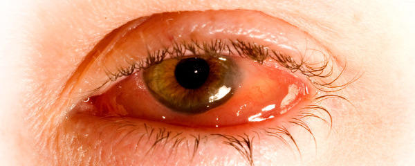 戴隐形眼镜眼睛红血丝是怎么回事 眼睛红血丝怎么消除