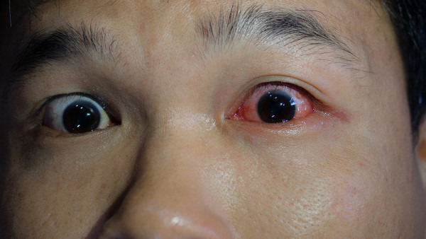 白眼球老有红血丝是怎么回事 白眼球老有红血丝该怎么进行治疗