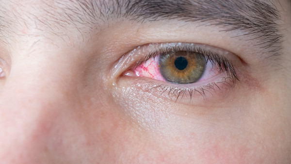 红眼病的初期症状表现是什么 红眼病该如何进行日常护理