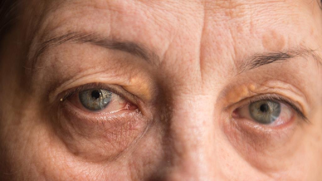 黄斑变性是什么样的眼病？为什么说黄斑变性比白内障危害更大