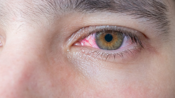 一只眼睛充血是怎么回事 眼睛充血的常见病因都有哪些