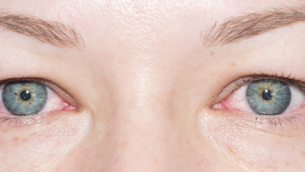 什么是红眼病 红眼病的注意事项都有哪些