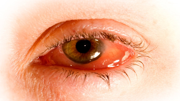 红眼病的初期症状是什么 预防红眼病的方法都有哪些