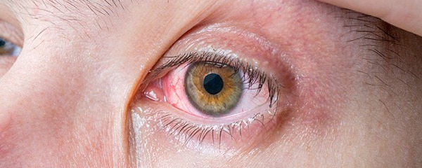 眼睛发炎怎么办好得快 眼睛发炎的症状表现都有哪些
