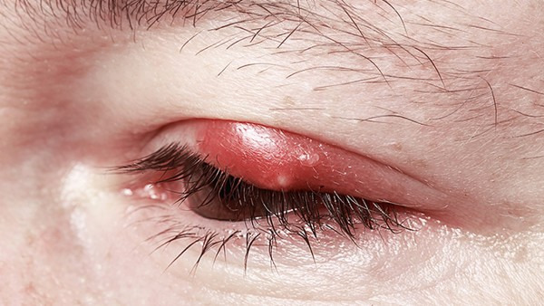 眼睛变红是怎么回事 或许是经常性熬夜或用眼不当