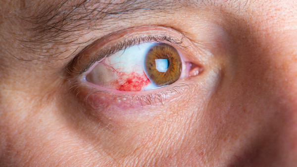 眼睛有红血块怎么办 眼睛有血块该如何进行治疗