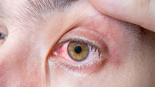 眼睛疼用什么眼药水 平常眼睛疼可以用这几款眼药水