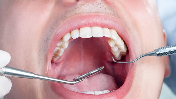 牙齿结石自己怎么弄掉 牙结石的清除方法都有哪些