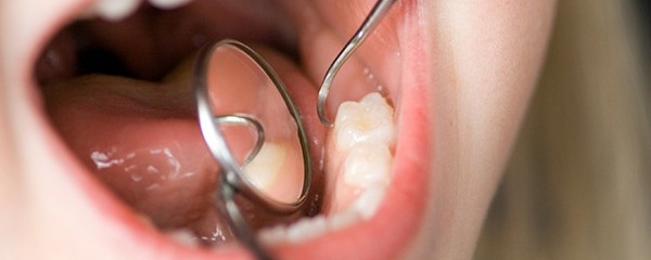 牙结石怎么去除 去除牙结石的小窍门都有哪些