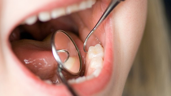 洗牙是怎么回事 洗牙的好处都有哪些