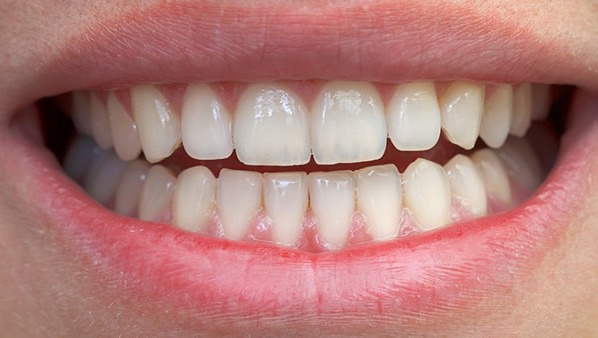 牙龈刮治会有什么危害 牙龈刮治的影响都有哪些