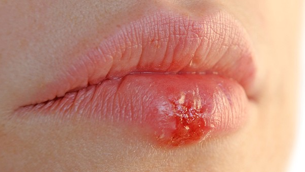 唇炎用什么药 日常怎么调理护理唇炎