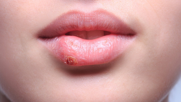 唇炎是怎么引起的怎么治疗，唇炎3个疗法和3个病因