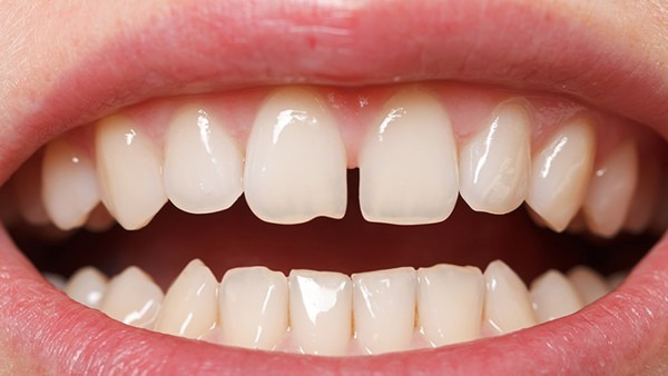 牙龈炎该应该如何进行治疗 牙龈发炎该如何用药