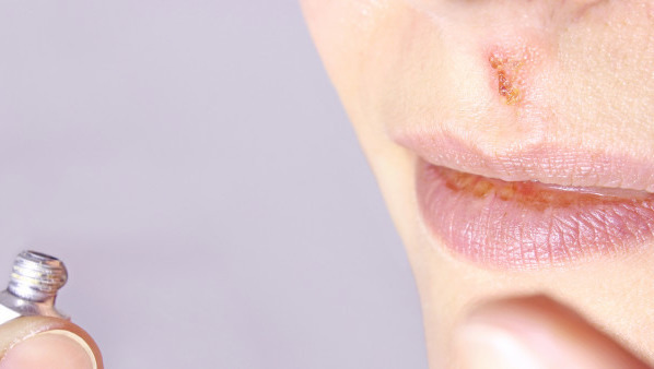口角炎唇炎吃什么药好，治疗口角炎唇炎可以吃3种药
