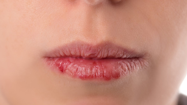红霉素软膏治唇炎好吗，红霉素软膏不能治疗所有唇炎