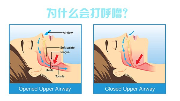 打鼾是什么原因？5原因了解真相