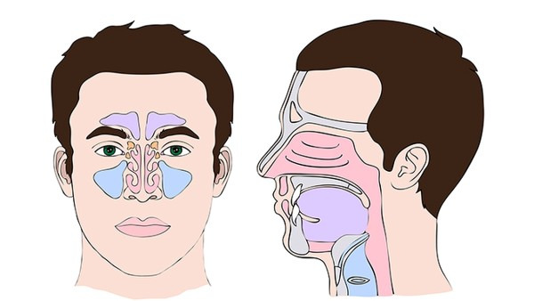鼻息肉有哪些危害 鼻息肉常见的4个并发症都分别是什么