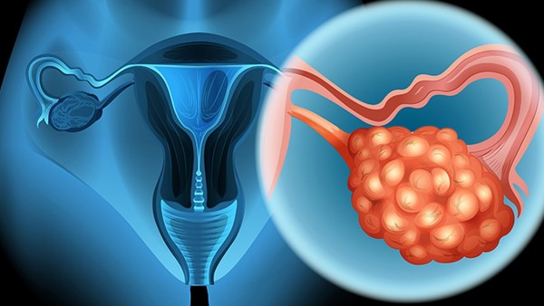 更年期卵巢囊肿怎么办？先知道所出现卵巢囊肿是什么性质