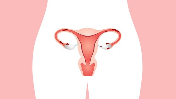 怎么抑制子宫内膜息肉的复发