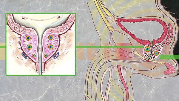 如何预防尿毒症 预防尿毒症的3种方法