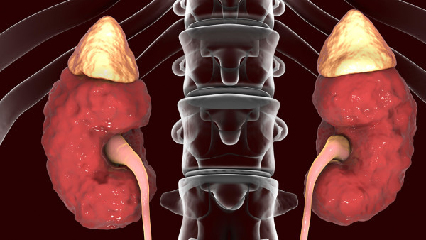 肾囊肿是怎么形成的 肾囊肿的发病机制是什么