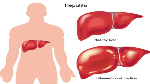 肝炎后吃什么好 肝炎患者要飲食清淡