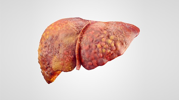 脂肪肝肝囊肿遗传吗 脂肪肝肝囊肿有遗传性吗