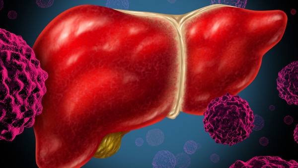 脂肪肝肝囊肿是早期癌症吗
