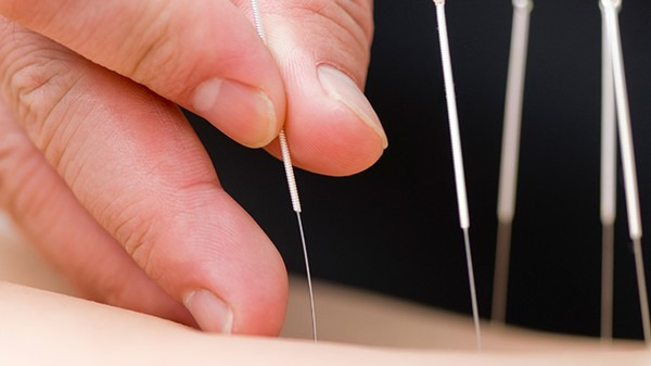 坐骨神经痛可以针灸吗