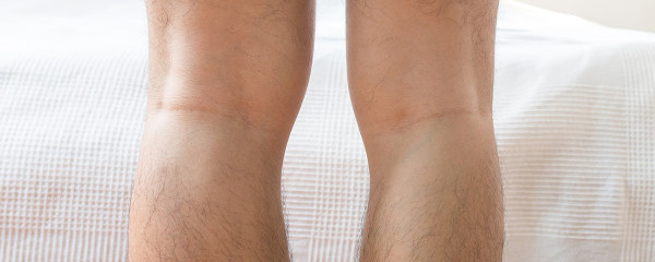 膝盖窝疼是什么原因导致的 膝盖窝疼怎么办才好