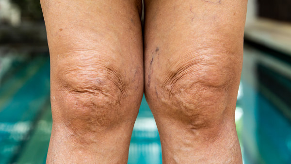 膝外翻是由哪些因素形成得 膝外翻的危害又有哪些