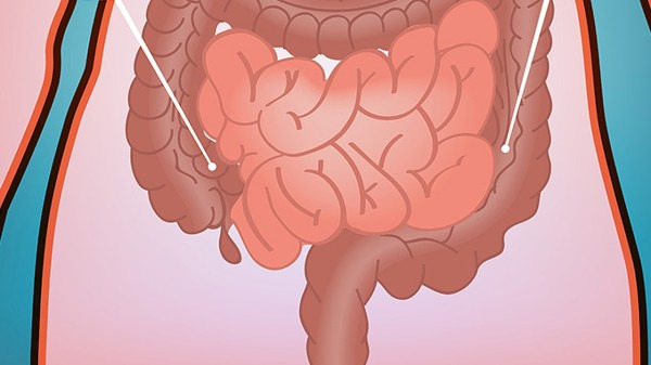 直肠息肉是怎么形成的 导致直肠息肉常见的4个因素都有哪些