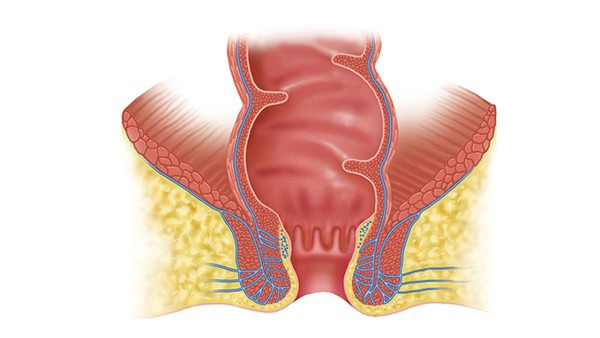 直肠息肉能根治吗 直肠息肉癌变前会出现什么症状
