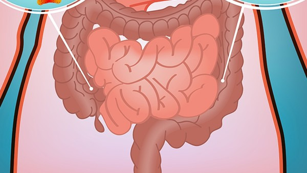 直肠息肉是怎么引起的 如何预防直肠息肉