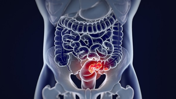 直肠息肉久治不愈会发生癌变吗 直肠息肉如何判断是良性还是恶性