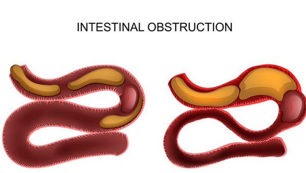 肠梗阻的最佳治疗方法是什么 肠梗阻会危及生命吗